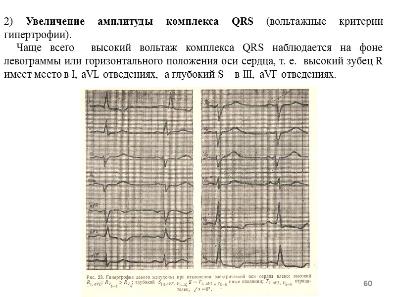 60 2) Увеличение амплитуды комплекса QRS (вольтажные критерии гипертрофии). 60 2) Увеличение амплитуды комплекса QRS (вольтажные критерии гипертрофии).